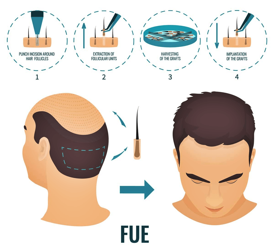 FUE (Follicular Unit Extraction)